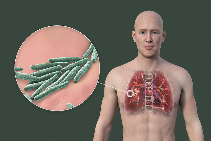 Lungs affected by cavernous tuberculosis, illustration Man with transparent skin, showcasing the lungs affected by cavernous tuberculosis, and close up view of Mycobacterium tuberculosis bacteria., by KATERYNA KON SCIENCE PHOTO LIBRARY