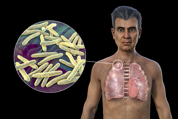 Lungs affected by apical tuberculosis, illustration Man with transparent skin, revealing the lungs affected by apical tuberculosis, and close up view of Mycobacterium tuberculosis bacteria., by KATERYNA KON SCIENCE PHOTO LIBRARY