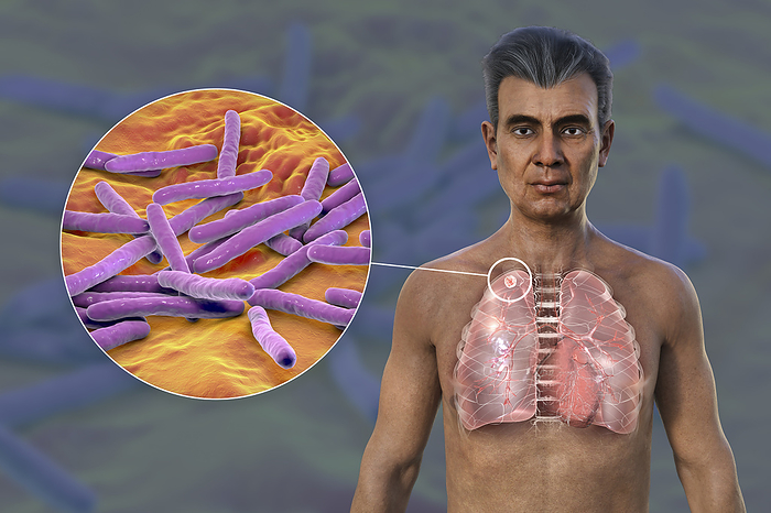 Lungs affected by apical tuberculosis, illustration Man with transparent skin, revealing the lungs affected by apical tuberculosis, and close up view of Mycobacterium tuberculosis bacteria., by KATERYNA KON SCIENCE PHOTO LIBRARY