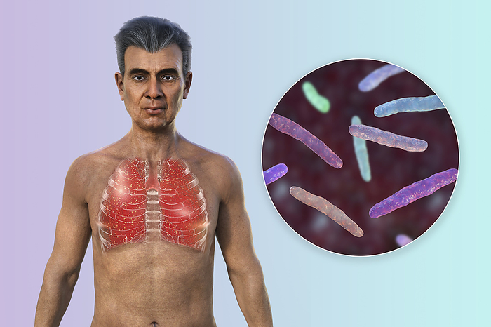 Lungs affected by miliary tuberculosis, illustration Man with transparent skin, showcasing the lungs affected by miliary tuberculosis, and close up view of Mycobacterium tuberculosis bacteria., by KATERYNA KON SCIENCE PHOTO LIBRARY