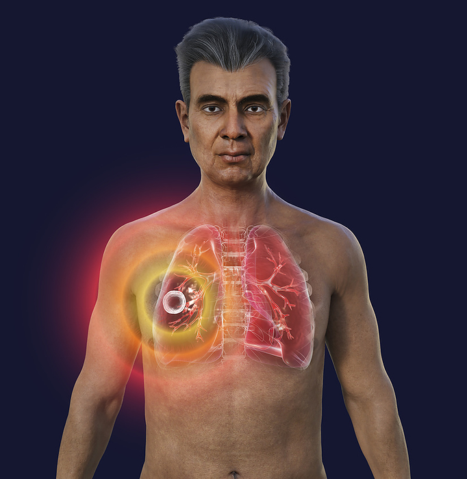 Lungs affected by cavernous tuberculosis, illustration Man with transparent skin, showcasing the lungs affected by cavernous tuberculosis., by KATERYNA KON SCIENCE PHOTO LIBRARY