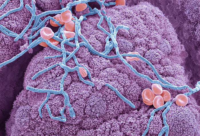 Fungal infection of the gut, SEM Fungal infection of the gut. Coloured scanning electron micrograph  SEM  of fungal hyphae in the gut. Red blood cells are also present. Fungal infections are one of the most significant causes of morbidity and mortality in immunocompromised patients. The incidence of invasive fungal infections, including those of the gastrointestinal tract, has increased significantly as numbers of immunocompromised patients have increased. The diagnosis of fungal infections in immunocompromised patients may be particularly problematic as these patients may present with atypical clinical features. Although Candida and Aspergillus species represent the majority of fungi diagnosed in the immunocompromised patient population, other fungi are emerging as increasingly common pathogens. Magnification: x3000 when printed 10 centimetres wide., by STEVE GSCHMEISSNER SCIENCE PHOTO LIBRARY