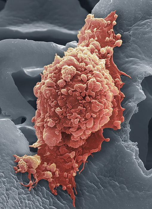 Hela cell, SEM HeLa cell. Coloured scanning electron micrograph  SEM  of a HeLa cell grown in a 3D matrix  background . HeLa cells are a continuously cultured cell line of immortal human cancer cells derived from cervical cancer cells. As they are immortal they thrive in the laboratory and are widely used in biological and medical research. Cancer of the cervix  the neck of the uterus  is one of the most common cancers affecting women. Magnification: x4000 when printed at 10 centimetres wide., by STEVE GSCHMEISSNER SCIENCE PHOTO LIBRARY