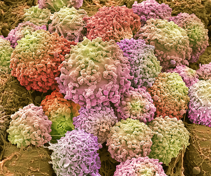 Neural organoid, SEM Organoid. Coloured scanning electron micrograph  SEM  of a neural organoid  courtesy of Sam Jackson . An organoid is a culture system composed of free floating clusters of neural stem cells overlying evolving neurones  not visible here . Since neural stem cells cannot be studied in vivo   within the body , organoids provide a method to investigate neural precursor cells in vitro  outside the body . Neural stem cells that are transplanted are able to cross the blood brain barrier and integrate themselves into the host s brain without disrupting normal function. This therapeutic application of neural stem cells derived from organoids is still in its infancy with respect to efficacy, but it has a high potential for success in treating many diseases. Magnification: x200 when printed at 10 centimetres wide., by STEVE GSCHMEISSNER SCIENCE PHOTO LIBRARY