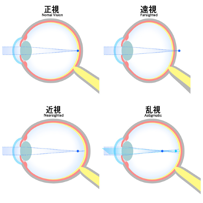Illustration of a normal, nearsighted, farsighted, and astigmatic eye