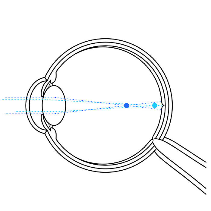 Illustration of an eye with myopic positive astigmatism