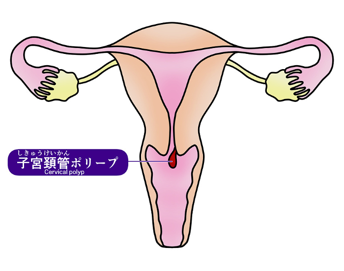 Simple illustration of cervical polyp