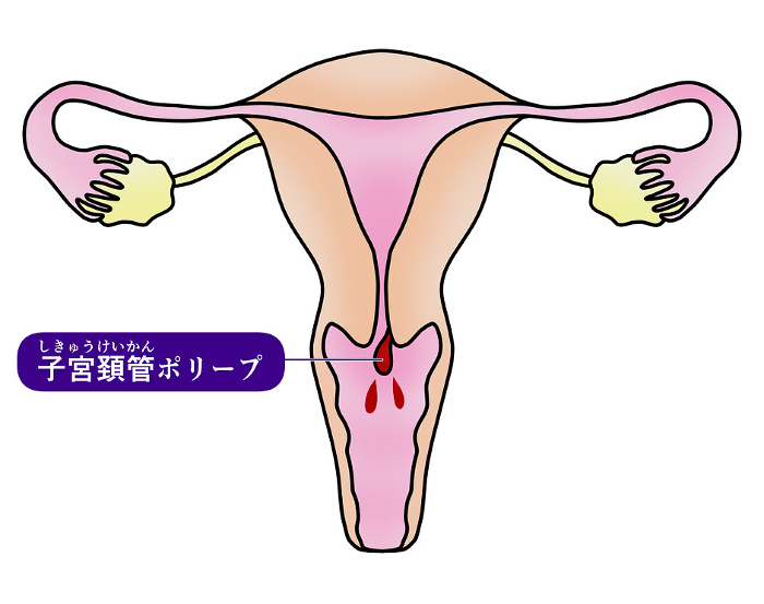 Simple illustration of cervical polyp