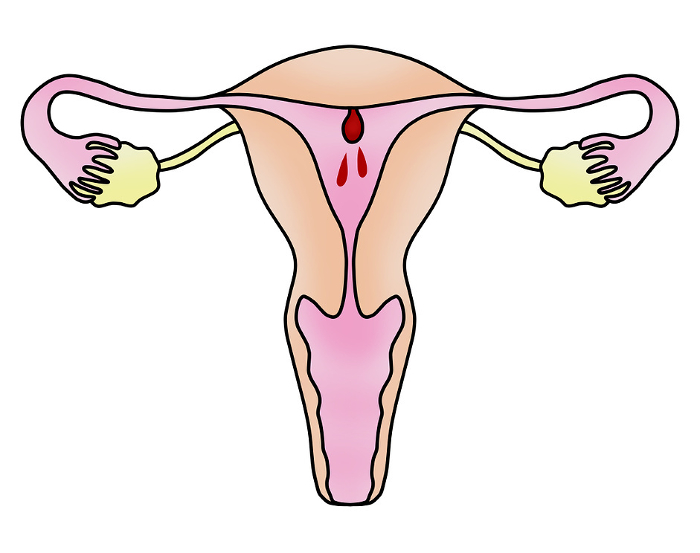 Simple illustration of endometrial polyp