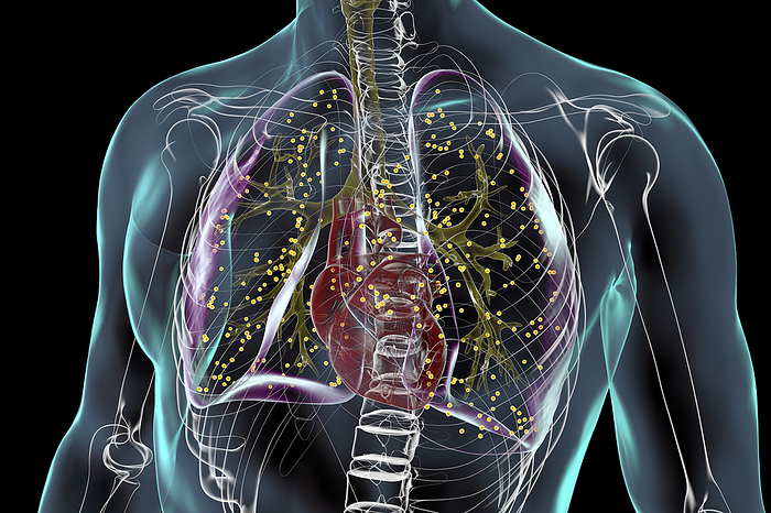 Lungs affected by miliary tuberculosis, illustration Human lungs affected by miliary tuberculosis, illustration., by KATERYNA KON SCIENCE PHOTO LIBRARY