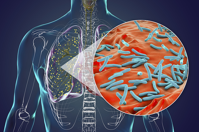 Lungs affected by miliary tuberculosis, illustration Human lungs affected by miliary tuberculosis, with a close up view of the Mycobacterium tuberculosis bacteria, illustration., by KATERYNA KON SCIENCE PHOTO LIBRARY