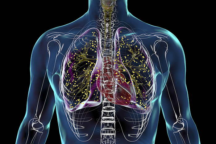 Lungs affected by miliary tuberculosis, illustration Human lungs affected by miliary tuberculosis, illustration., by KATERYNA KON SCIENCE PHOTO LIBRARY