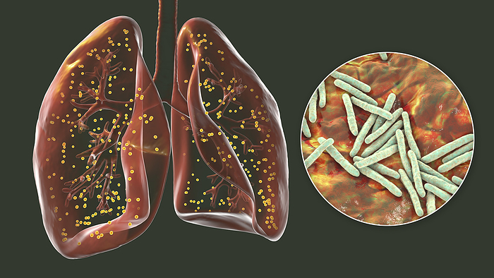 Lungs affected by miliary tuberculosis, illustration Human lungs affected by miliary tuberculosis and close up view of Mycobacterium tuberculosis, illustration., by KATERYNA KON SCIENCE PHOTO LIBRARY
