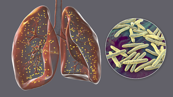 Lungs affected by miliary tuberculosis, illustration Human lungs affected by miliary tuberculosis and close up view of Mycobacterium tuberculosis, illustration., by KATERYNA KON SCIENCE PHOTO LIBRARY