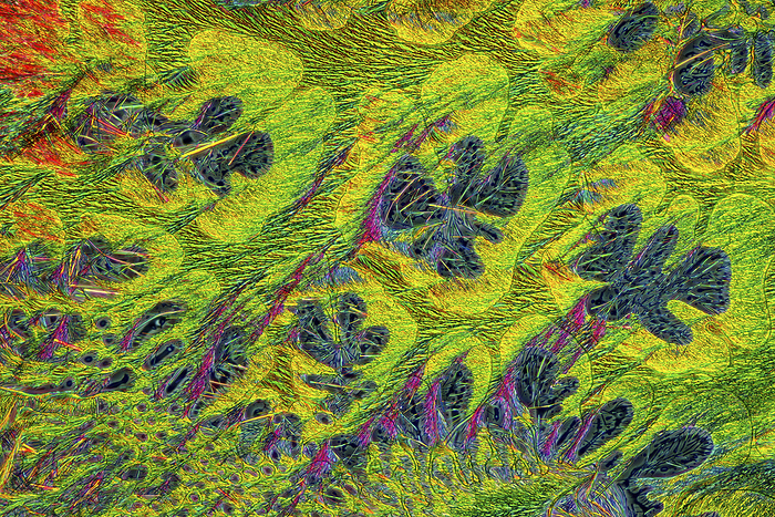 Callus remover crystals, light micrograph Polarised light micrograph of callus remover crystals, a mixture of salicylic acid and lactic acid. Callus remover medications are used to remove calluses, areas of thickened skin that form as a response to repeated friction, pressure or other irritation. Magnification: x93 when printed 10 centimetres wide., by MAREK MIS SCIENCE PHOTO LIBRARY
