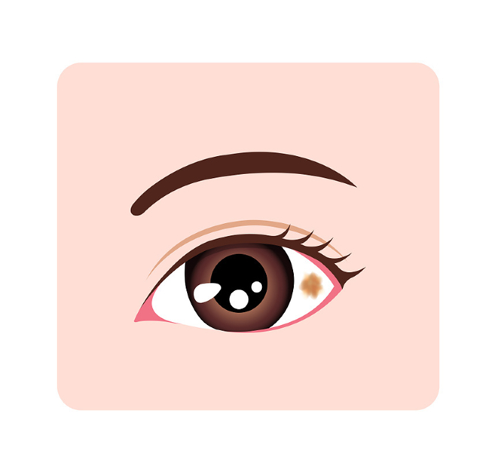 Conjunctival nevus (magnified eye) vector illustration