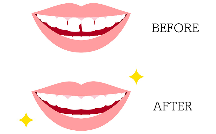 Cosmetic Dentistry, Direct Bonding Before and After