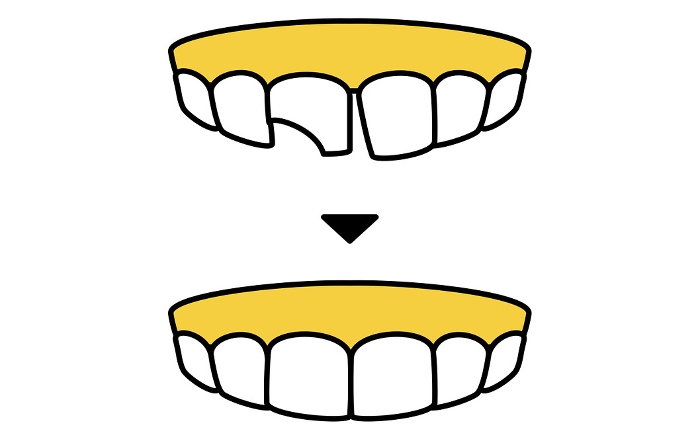 Cosmetic dentistry, direct bonding before and after, simple line drawing