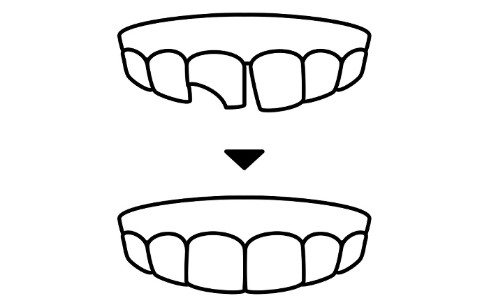 Cosmetic dentistry, direct bonding before and after, simple line drawing