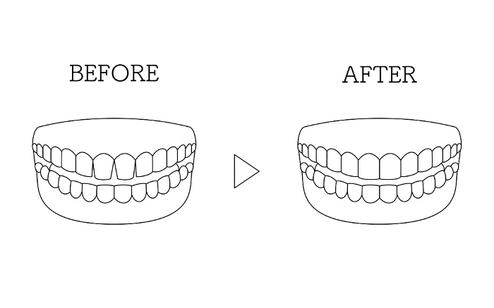Cosmetic Dentistry, Direct Bonding Before and After, Gapped Anterior Teeth