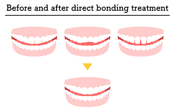 Cosmetic dentistry: treatment with direct bonding, decayed or chipped teeth, and gaps