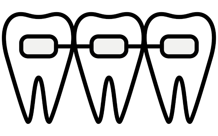 Dentistry: Orthodontic appliances and metal brackets used to straighten teeth