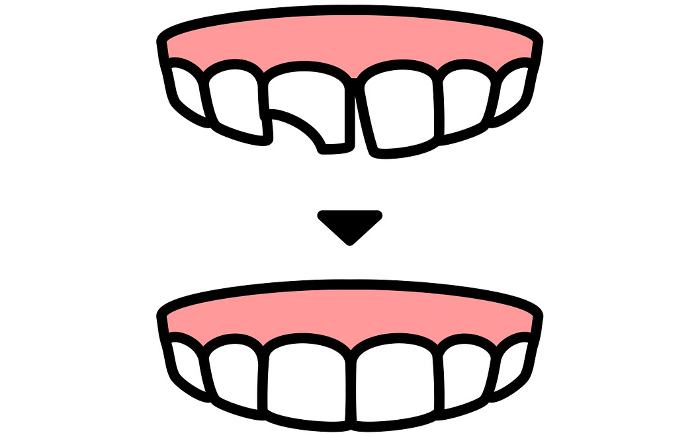 Dentistry: Direct Bonding Before and After, Simple Line Drawing