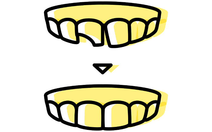 Dentistry: Direct Bonding Before and After, Simple Line Drawing