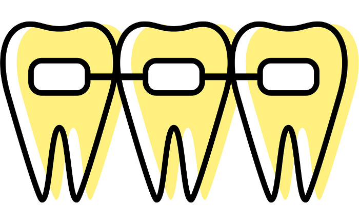Dentistry: Orthodontic appliances and metal brackets used to straighten teeth