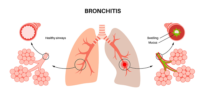 Bronchitis lung disease, illustration Bronchitis lung disease, illustration., by PIKOVIT   SCIENCE PHOTO LIBRARY