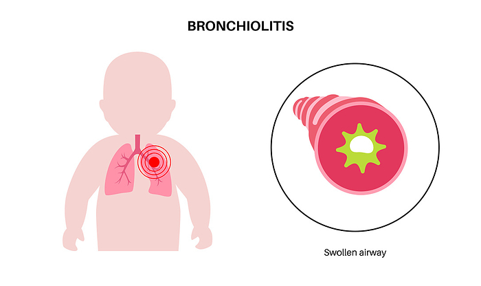 Bronchiolitis lung disease, illustration Bronchiolitis lung disease, illustration., by PIKOVIT   SCIENCE PHOTO LIBRARY