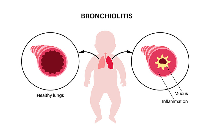 Bronchiolitis lung disease, illustration Bronchiolitis lung disease, illustration., by PIKOVIT   SCIENCE PHOTO LIBRARY