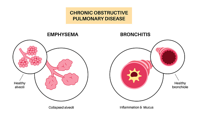 Chronic obstructive pulmonary disease, illustration Chronic obstructive pulmonary disease  COPD , illustration., by PIKOVIT   SCIENCE PHOTO LIBRARY