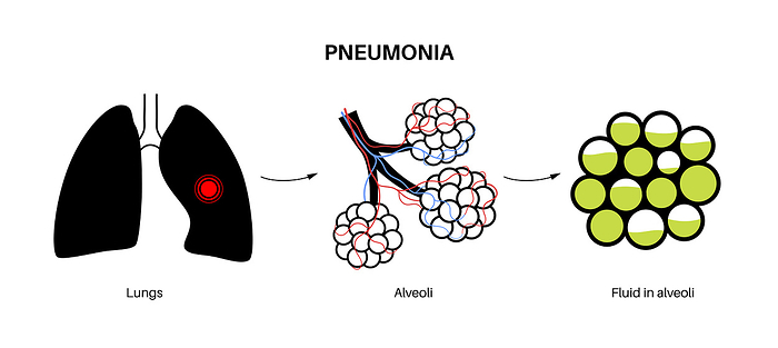 Pneumonia, illustration Pneumonia, illustration., by PIKOVIT   SCIENCE PHOTO LIBRARY