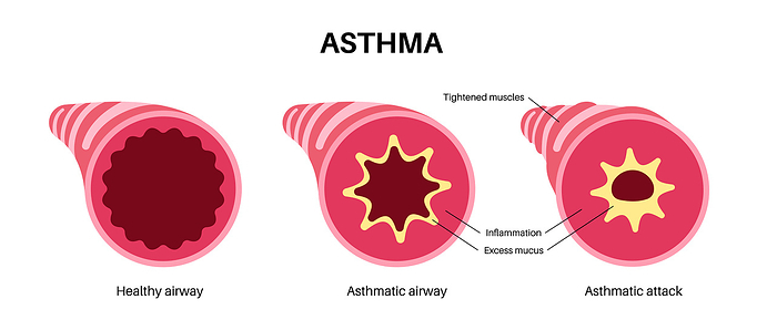 Asthma, illustration Asthma, illustration., by PIKOVIT   SCIENCE PHOTO LIBRARY