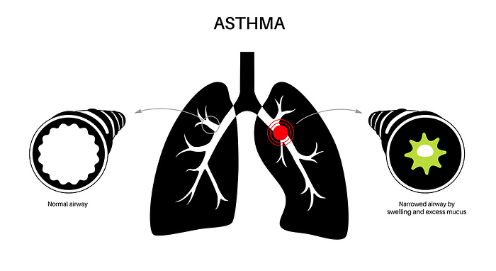 Asthma, illustration Asthma, illustration., by PIKOVIT   SCIENCE PHOTO LIBRARY