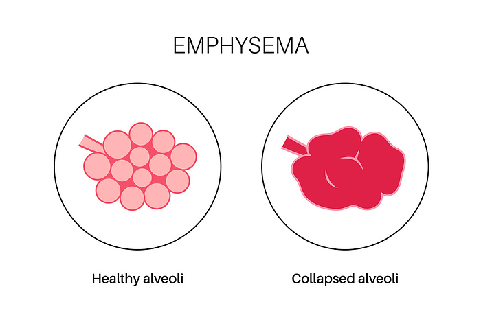 Emphysema, illustration Emphysema, illustration., by PIKOVIT   SCIENCE PHOTO LIBRARY