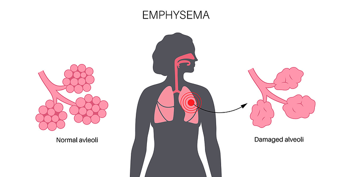Emphysema, illustration Emphysema, illustration., by PIKOVIT   SCIENCE PHOTO LIBRARY