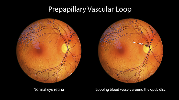 Prepapillary vascular loop on the retina, illustration Illustration of a prepapillary vascular loop on the retina, as observed during ophthalmoscopy. The looping blood vessels are around the optic disc., by KATERYNA KON SCIENCE PHOTO LIBRARY