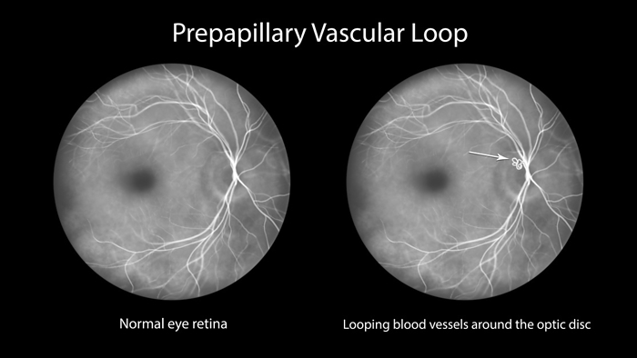 Prepapillary vascular loop on the retina, illustration Illustration of a prepapillary vascular loop on the retina, as observed during fluorescein angiography. The looping blood vessels are around the optic disc., by KATERYNA KON SCIENCE PHOTO LIBRARY