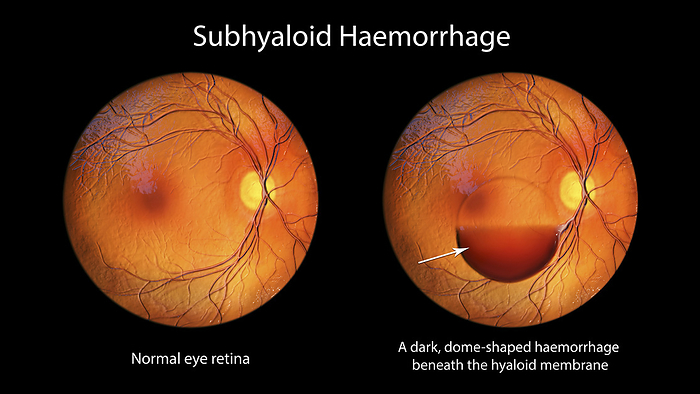 Subhyaloid haemorrhage on the retina, illustration Illustration of a subhyaloid haemorrhage on the retina as observed during ophthalmoscopy. There is a dark, dome shaped haemorrhage beneath the hyaloid membrane., by KATERYNA KON SCIENCE PHOTO LIBRARY