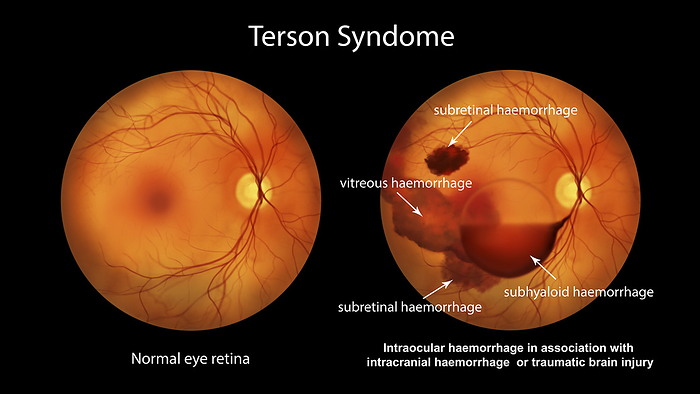 Intraocular haemorrhage in Terson syndrome, illustration Illustration depicting Terson syndrome, revealing intraocular haemorrhage observed during ophthalmoscopy, linked to intracranial haemorrhage or traumatic brain injury., by KATERYNA KON SCIENCE PHOTO LIBRARY