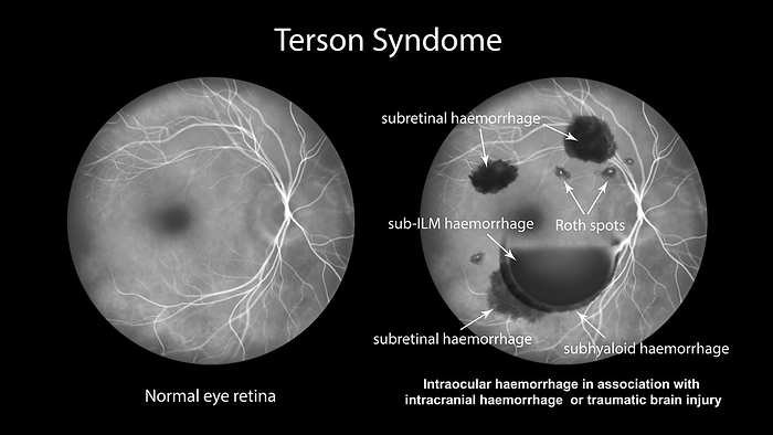 Intraocular haemorrhage in Terson syndrome, illustration Illustration depicting Terson syndrome, revealing intraocular haemorrhage observed during fluorescein angiography, linked to intracranial haemorrhage or traumatic brain injury., by KATERYNA KON SCIENCE PHOTO LIBRARY