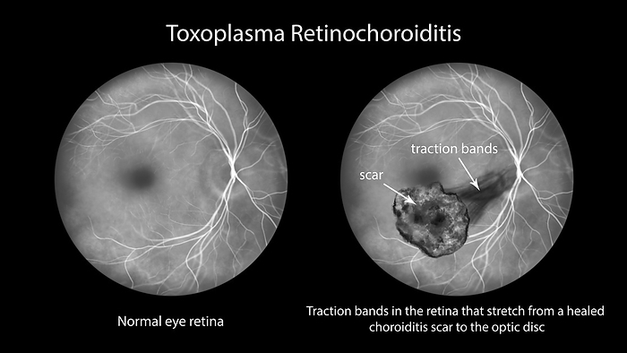 Toxoplasma retinochoroiditis, illustration Illustration depicting Toxoplasma retinochoroiditis observed during fluorescein angiography, showcasing traction bands stretching from a healed scar to the optic disk., by KATERYNA KON SCIENCE PHOTO LIBRARY
