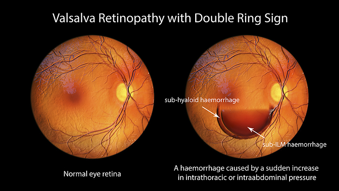 Valsava retinopathy, illustration Computer illustration of Valsalva retinopathy observed during ophthalmoscopy, showcasing retinal haemorrhages resulting from sudden increase in intraocular pressure with characteristic double ring sign., by KATERYNA KON SCIENCE PHOTO LIBRARY