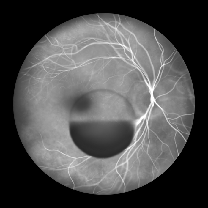 Subhyaloid haemorrhage, illustration Illustration of a subhyaloid haemorrhage on the retina as observed during fluorescein angiography, showcasing a dark, dome shaped haemorrhage beneath the hyaloid membrane., by KATERYNA KON SCIENCE PHOTO LIBRARY
