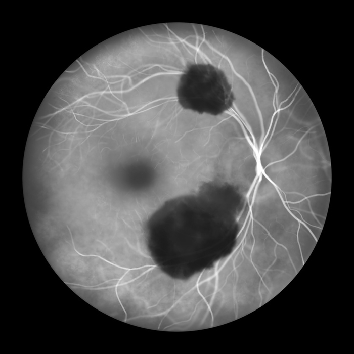 Subretinal haemorrhage, illustration Illustration of a subretinal haemorrhage observed during fluorescein angiography, revealing a dark, irregular haemorrhage beneath the retinal layers., by KATERYNA KON SCIENCE PHOTO LIBRARY