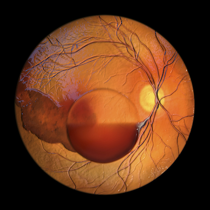 Intraocular haemorrhage in Terson syndrome, illustration Computer illustration depicting Terson syndrome, revealing intraocular haemorrhage observed during ophthalmoscopy, linked to intracranial haemorrhage or traumatic brain injury., by KATERYNA KON SCIENCE PHOTO LIBRARY