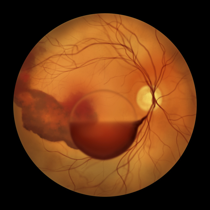 Intraocular haemorrhage in Terson syndrome, illustration Illustration depicting Terson syndrome, revealing intraocular haemorrhage observed during ophthalmoscopy, linked to intracranial haemorrhage or traumatic brain injury., by KATERYNA KON SCIENCE PHOTO LIBRARY