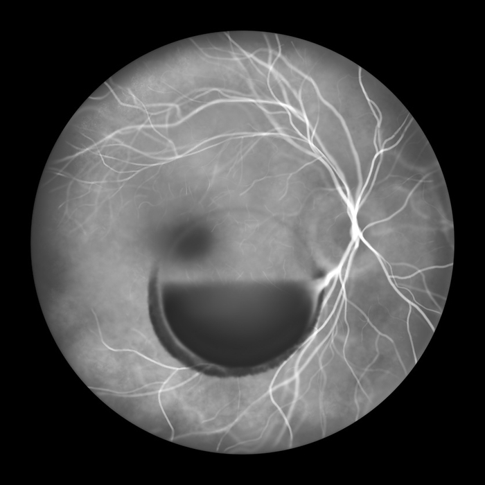 Valsava retinopathy, illustration Illustration of Valsalva retinopathy observed during fluorescein angiography, showing retinal haemorrhages resulting from sudden increase in intraocular pressure with characteristic double ring sign., by KATERYNA KON SCIENCE PHOTO LIBRARY